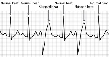 rapid or irregular beating of the heart figgerits|Rapid or irregular beating of the heart [ Figgerits Answers ].
